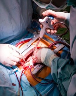 Open heart surgery topic article Custom