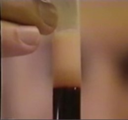 Test tube of fatty blood Custom