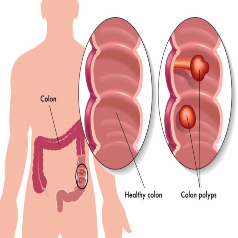 what foods help prevent colon polyps