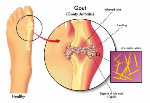 Is Your Diet "Rich" Enough to get Gout?