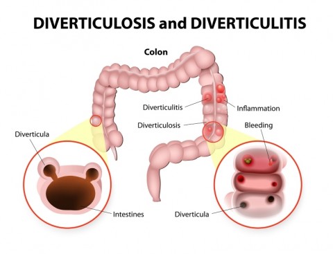 What is Diverticulosis and What Causes it?
