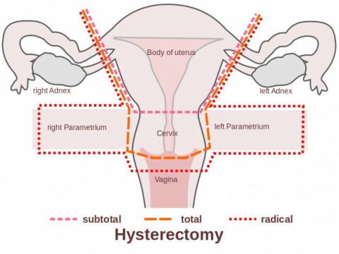 Laura Avoids Hysterectomy