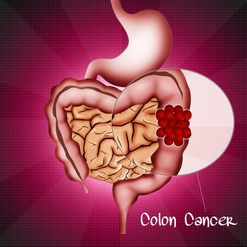 Colorectal Cancer Rising in Young Adults
