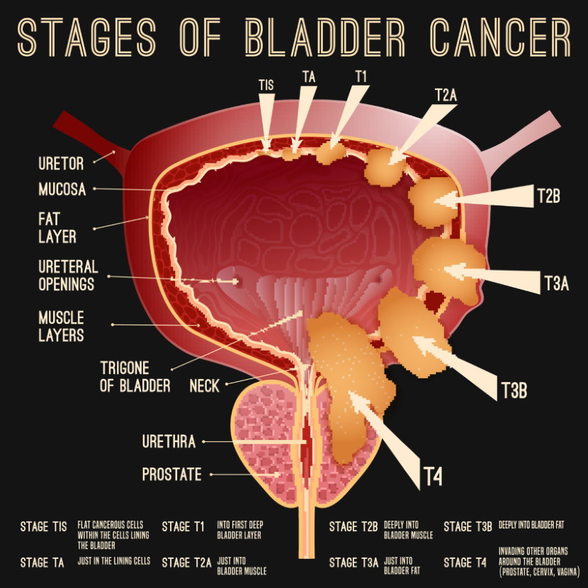 Symptoms And Diagnosis Of Bladder Cancer - Tabitomo