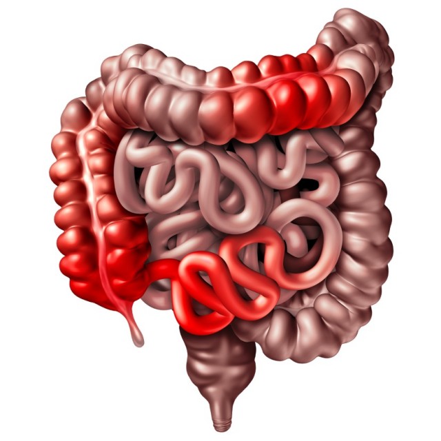 Illustration of Inflamed Large and Small Intestines