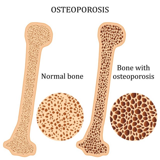 Normal Bone and Bone with Osteoporosis Comparison