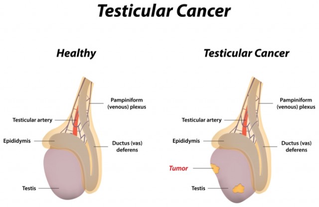 Testicular Cancer Diagram