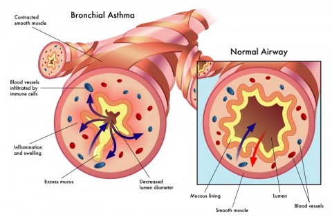 Bronchial Asthma Illustration