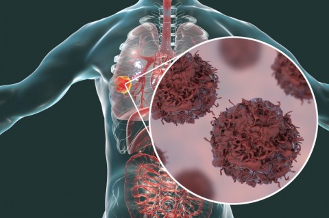 Lung Cancer Diagram