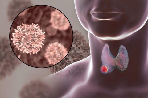Thyroid Cancer Illustration 