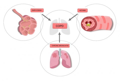 Types of Chronic Obstructive Pulmonary Disease (COPD)