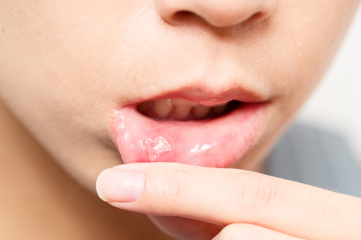 Could Mouth Ulcers be Caused by Dairy? - DrCarney.com Blog ...